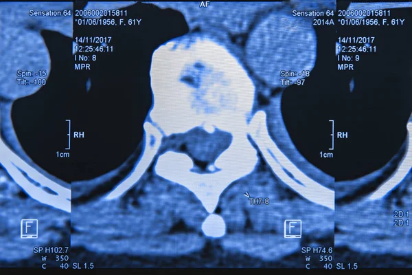 Spine MRI x-ray — Stock Photo, Image