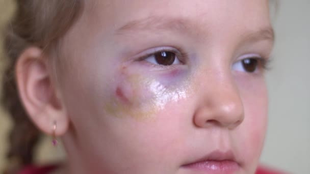 Domestic violence. Sad little girl with a black eye. Close up. Fear. — ストック動画