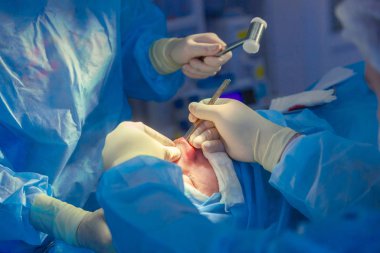 Cerrah ve asistanı hastane ameliyathanede burun üzerinde kozmetik cerrahi gerçekleştiriyor. Burun yeniden şekillendirme, augmentasyon. Rinoplasti. Çekiç.