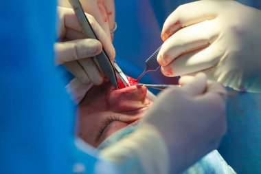 Cerrah ve hastane ameliyathane burnuna estetik ameliyat asistanı. Burnun yeniden şekillendirilmesi, büyütme. Burun estetiği.