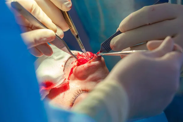 Cirujano y su asistente realizando cirugía estética en la nariz en el quirófano del hospital. Remodelación de la nariz, aumento. Rinoplastia . —  Fotos de Stock