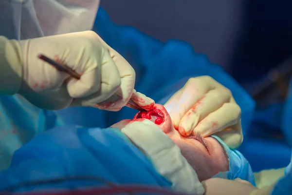 Surgeon and his assistant performing cosmetic surgery on nose in hospital operating room. Nose reshaping, augmentation. Rhinoplasty. — Stock Photo, Image