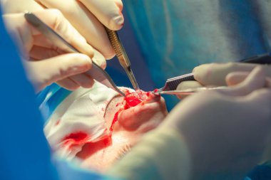 Cerrah ve hastane ameliyathane burnuna estetik ameliyat asistanı. Burnun yeniden şekillendirilmesi, büyütme. Burun estetiği.