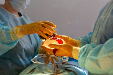 Hastanedeyiz. Cerrah ameliyathanede ameliyat yapar. Doktor ve hemşire göğüs büyütme ameliyatı sırasında yerleştirmeden önce implantı dezenfekte ederler..