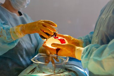 Hastanedeyiz. Cerrah ameliyathanede ameliyat yapar. Doktor ve hemşire göğüs büyütme ameliyatı sırasında yerleştirmeden önce implantı dezenfekte ederler..