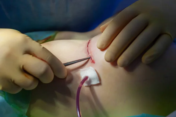 Hospital. Surgeon operates in the operating room. Close up of the surgeons hands examining the suture on the patients breast after plastic surgery