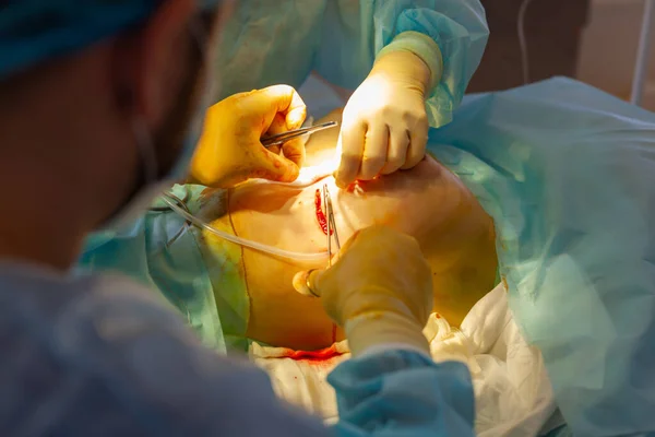 Sjukhuset. Kirurgen opererar i operationssalen. Kirurgen syr ihop snittet på bröstet efter att implantatet har satts in. — Stockfoto