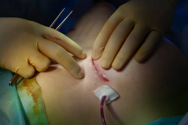 Hospital. Surgeon operates in the operating room. Close up of the surgeons hands examining the suture on the patients breast after plastic surgery