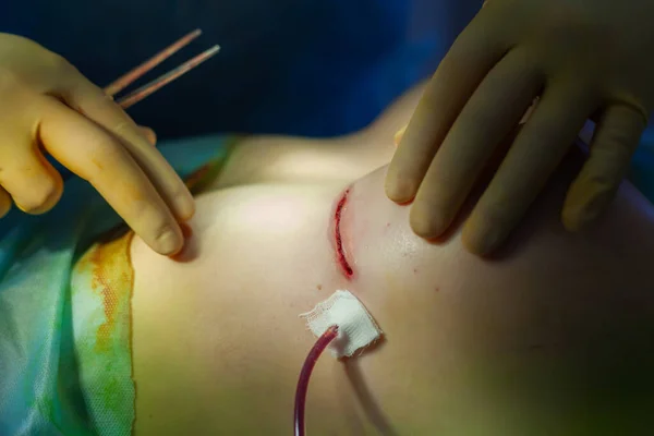 Sjukhuset. Kirurgen opererar i operationssalen. Närbild av kirurger händer undersöka suturen på patienterna bröst efter plastikkirurgi — Stockfoto