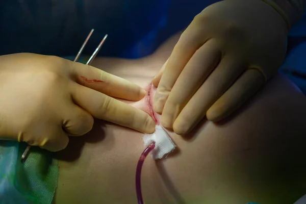 Hospital. Surgeon operates in the operating room. Close up of the surgeons hands examining the suture on the patients breast after plastic surgery — Stock Photo, Image