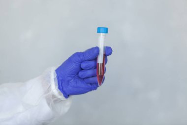 Eldivendeki doktor kan örneğini COVID, COVID-19, koronavirüs üzerinde salgını durdurmak için test ediyor.