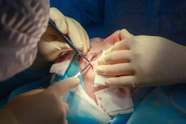 Primer plano de la cara de un paciente que se somete a una blefaroplastia. El cirujano corta el párpado y realiza manipulaciones utilizando instrumentos médicos —  Fotos de Stock