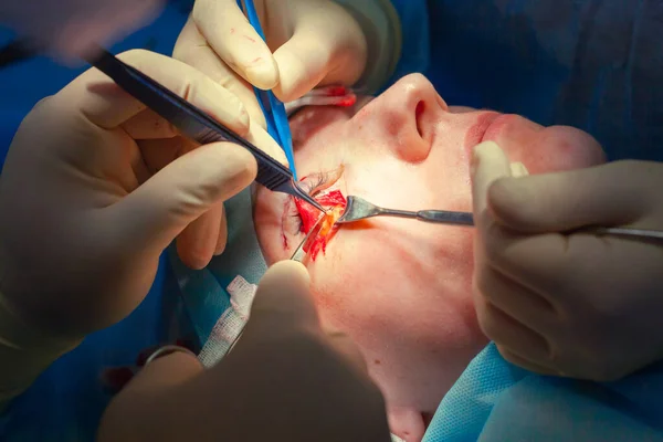 탈장증을 앓고 있는 환자의 얼굴을 가까이 서 보 십시오. 의사는 눈꺼풀을 자르고 의료 기구를 사용하여 수술을 한다 — 스톡 사진