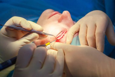 Kan pıhtılaşması geçiren bir hastanın yüzünü kapatın. Cerrah göz kapağını keser ve tıbbi aletlerle manipülasyon yapar.