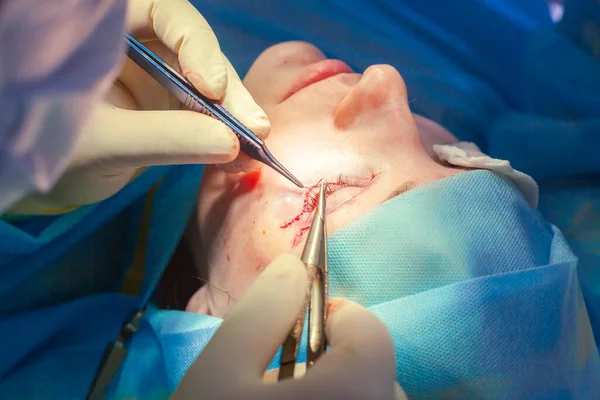 Nahaufnahme des Gesichts eines Patienten, der sich einer Blepharoplastik unterzieht. Der Chirurg schneidet das Augenlid und führt Manipulationen mit medizinischen Instrumenten durch — Stockfoto