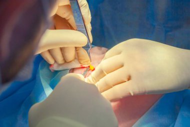 Ameliyat sırasında cerrah özel aletlerle hastanın göz kapağındaki yağı temizler.