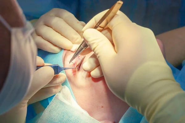 Nahaufnahme des Gesichts eines Patienten, der sich einer Blepharoplastik unterzieht. Der Chirurg schneidet das Augenlid und führt Manipulationen mit medizinischen Instrumenten durch — Stockfoto