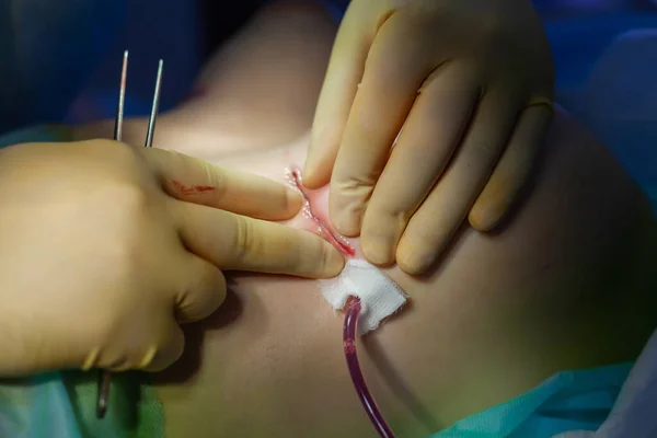 No hospital. O cirurgião opera na sala de operações. Close up das mãos dos cirurgiões examinando a sutura na mama pacientes após cirurgia plástica — Fotografia de Stock