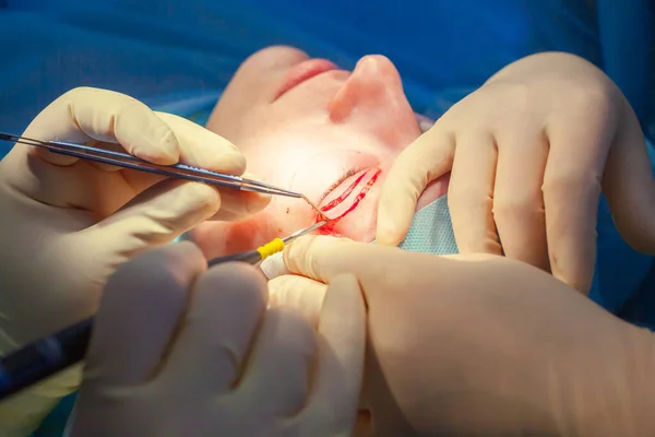 Nahaufnahme des Gesichts eines Patienten, der sich einer Blepharoplastik unterzieht. Der Chirurg schneidet das Augenlid und führt Manipulationen mit medizinischen Instrumenten durch — Stockfoto