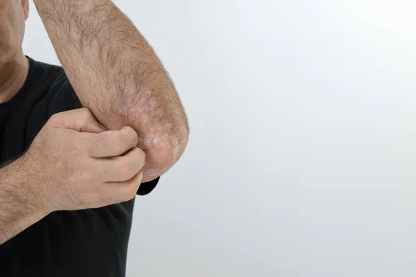 Psoriasi lesioni cutanee — Foto Stock