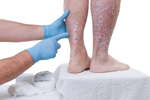 Psoriasi lesioni cutanee — Foto Stock