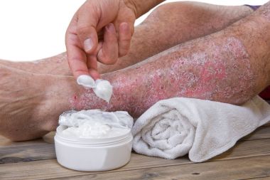 Psoriasis skin lesions clipart