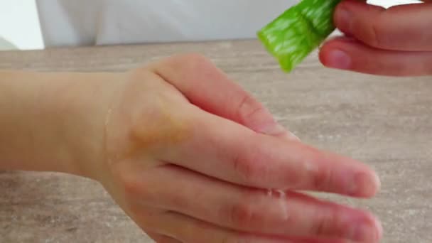 Manos aplicando gel de aloe vera sobre una quemadura en la piel . — Vídeo de stock