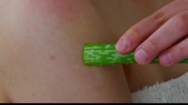 Genç bir kadın omzunda aloe vera kullanıyor.