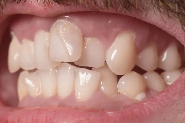 Primo piano di denti molto storti in un adulto barbuto. Non e 'il morso giusto. Denti non sani. Violazione della posizione dei denti nelle mascelle — Foto Stock