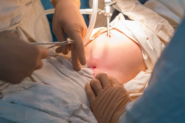 Menutup operasi laparoskopik di ruang operasi steril. Jahitan permanen dari cincin dalam. — Stok Foto
