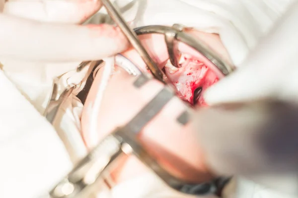 hands of a dentist doctor, closeup. The operation to eliminate the defect of the cleft palate, pathology of the hard palate. The child\'s mouth is open by the conservative, a bloody wound, gaping.