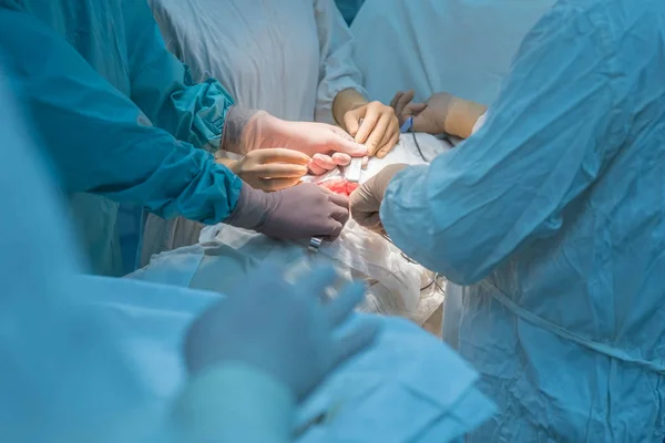 Uma equipe de cirurgiões realizando uma operação renal em uma sala de cirurgia estéril — Fotografia de Stock