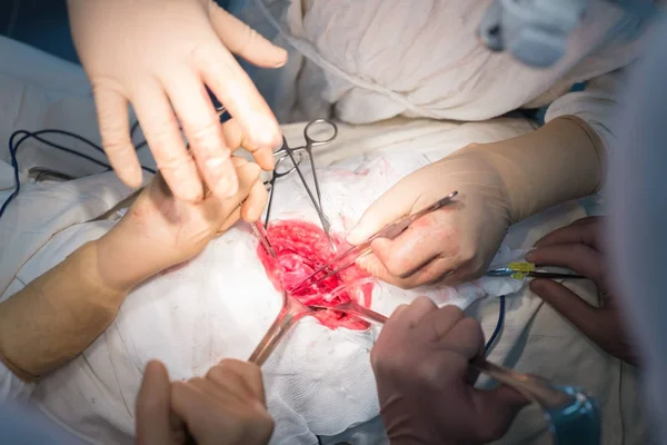 Chirurg z asystentami, w sterylnej sali operacyjnej, jest operowany na organach wewnętrznych. — Zdjęcie stockowe