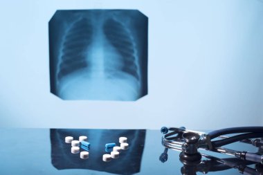 tuberculosis treatment concept. X-ray of the lungs, with pathology, phonendoscope with pills on the table. clipart
