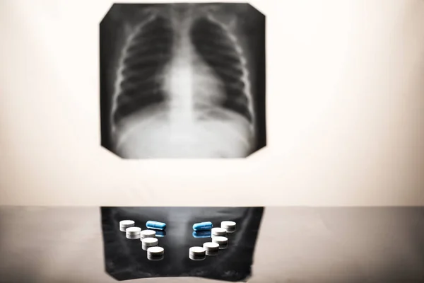 Tuberkulózis kezelési koncepció. A tüdő röntgenje, patológiával, fonendoszkóppal, tablettákkal az asztalon.. — Stock Fotó