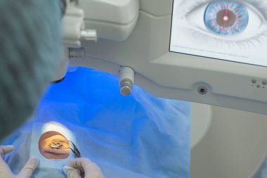 Doktor göz doktoru, görsel bozukluğun düzeltilmesi için modern bir lazer başlatmak için kontrol ekranındaki düğmeye basıyor. Lazer göz mikrocerrahisi.