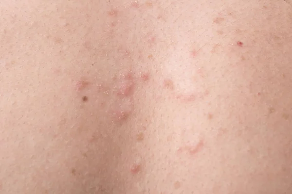 streptococcal skin infection, in the form of rash elements. Folliculitis of the skin of the back.
