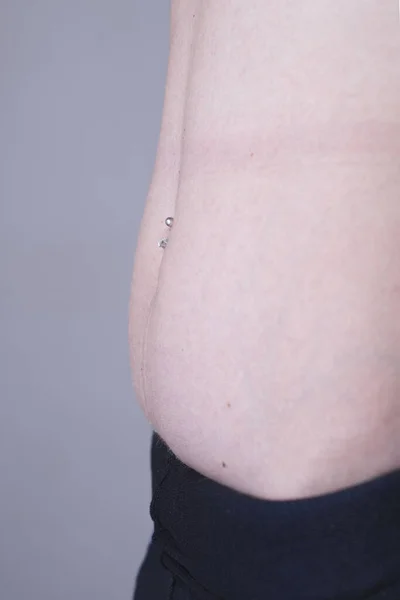 one of the stages of postpartum excess growth of adipose tissue and skin of the abdomen after surgery during childbirth. Close-up belly of a girl with a postpartum belly