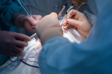 Steril bir ameliyathanede asistanları olan bir cerrah iç organları ameliyat eder. Mavi soğuk cerrahi parıltı. Cerrahın elleri aleti tutuyor, manipüle ediyor. Çocuk cerrahları böbrek ameliyatı yapıyor.