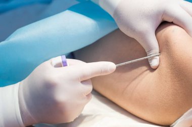 Uzun iğne kullanan bir onkolog, çocuklarda lösemi, Ewing sarkomu ve kemik iltihabı hastalığı teşhisi koymak için ileumu delmiş. Kemik kanseri teşhisi Pediatrik onkoloji