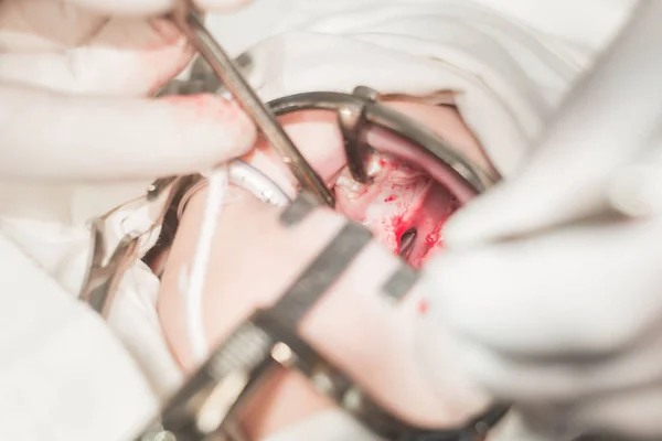 Ręce Lekarza Dentysty Zbliżenie Operacja Usunięcia Wady Rozszczepu Podniebienia Patologia — Zdjęcie stockowe