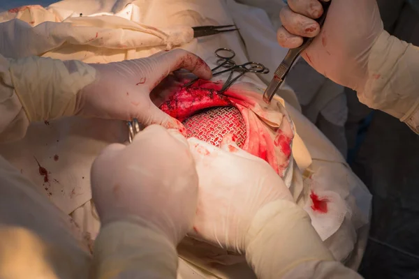 Hastaların Kafatasına Titanyum Plaka Yerleştirmek Için Yapılan Nörocerrahi Ameliyatın Üst — Stok fotoğraf