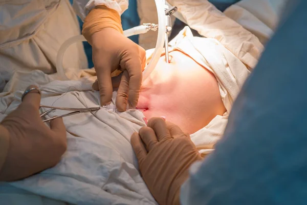 close-up hands of pediatric surgeons perform surgery using laparoscopic ports for endoscopic surgery. In a sterile operating room. Pediatric surgery, treatment of inguinal hernia in children by PIRS, suturing of the internal inguinal ring. Dropsy of