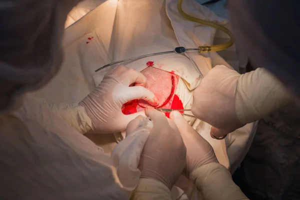 Widok Góry Etapy Operacji Neurochirurgicznej Instalacji Płytki Tytanowej Czaszce Pacjenta — Zdjęcie stockowe