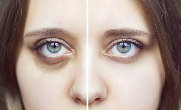 Ojos Verdes Femeninos Con Moretones Debajo Los Ojos Antes Después — Foto de Stock