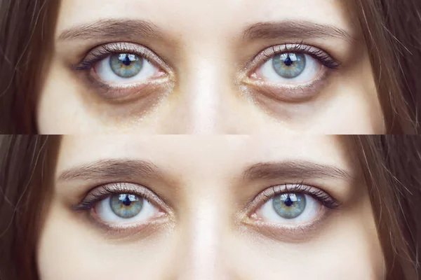Ojos Verdes Femeninos Con Moretones Debajo Los Ojos Antes Después —  Fotos de Stock