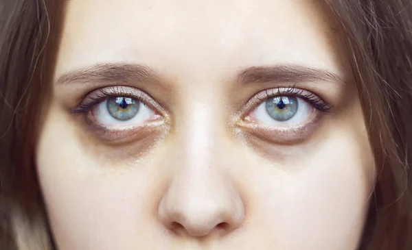 Женские Зеленые Глаза Синяками Глазами После Косметического Лечения — стоковое фото