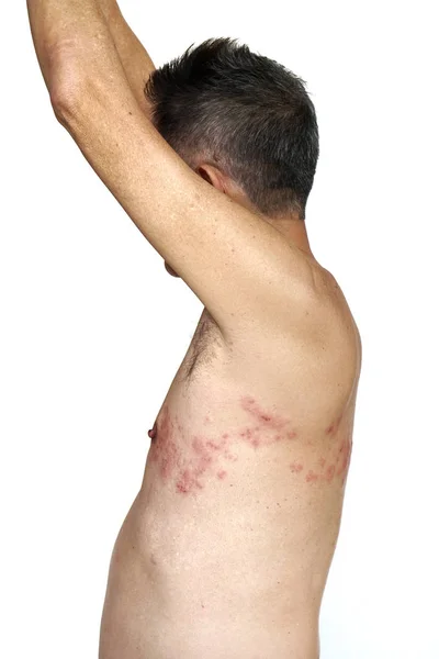Herpes zóster en el lado izquierdo del torso sobre el fondo blanco — Foto de Stock