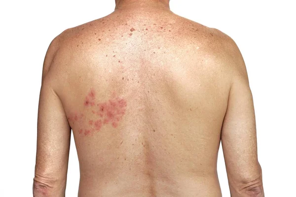 Herpes zoster aan de rechterkant van de romp op de witte achtergrond — Stockfoto