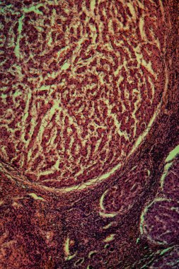 Mikroskop altında sirozlu hastalıklı karaciğer 100 kat.